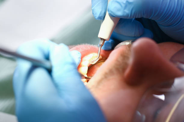 Best Emergency Treatment for Dental Infections or Abscesses in Galena Park, TX